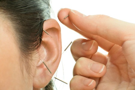 LOA ACUPUNCTURE | Evolution Medical Associates, 604 Druid Rd, Clearwater, FL 33756, USA | Phone: (737) 242-0402