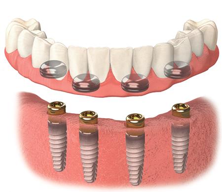 Dental Implant Aesthetic Center | 795 Ridge Lake Blvd Suite 101, Memphis, TN 38120, United States | Phone: (901) 682-5001