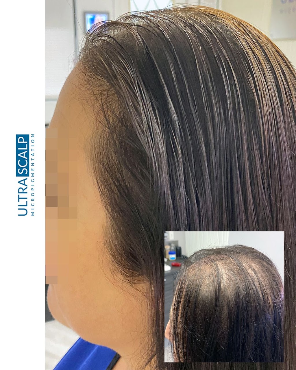 Ultra Scalp Micropigmentation | 4971 Van Dyke Rd, Lutz, FL 33558, USA | Phone: (813) 906-8696