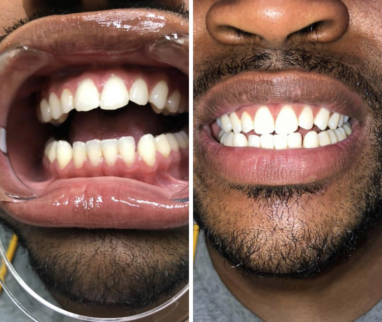 Snow White Teeth Services LLC | 11720 Beltsville Dr Suite 500, Beltsville, MD 20705, USA | Phone: (202) 213-6062