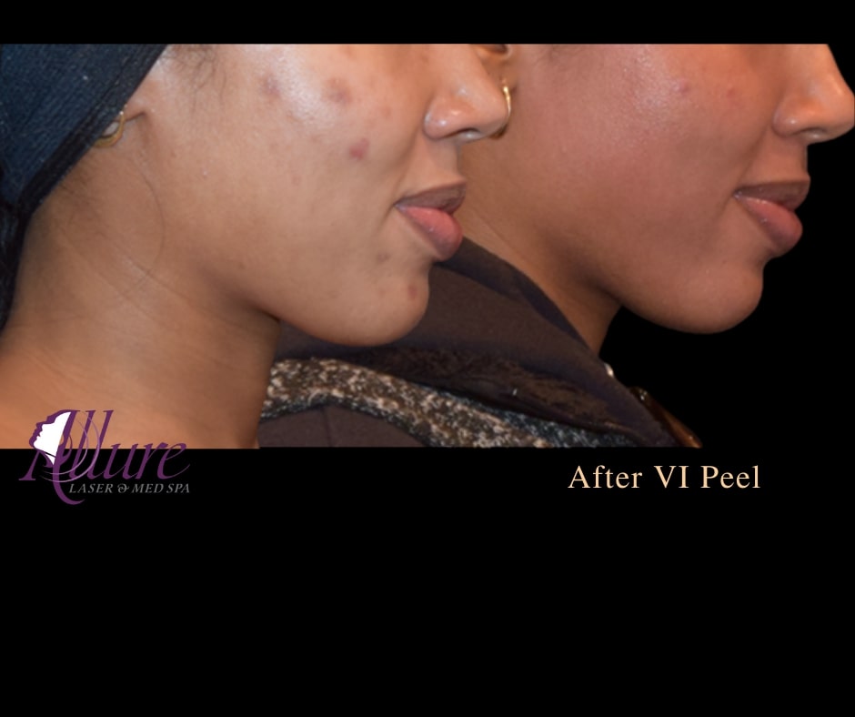 Allure Laser & Med Spa | 7151 183rd St, Tinley Park, IL 60477, USA | Phone: (708) 864-4988