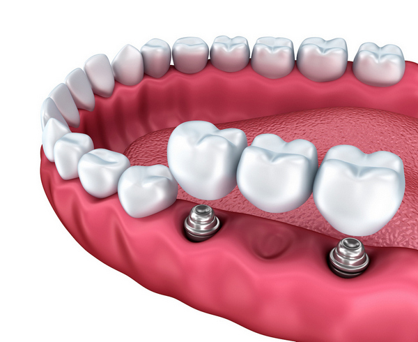 Partial Denture Albany | 435 New Scotland Ave, Albany, NY 12208, USA | Phone: (518) 500-9984