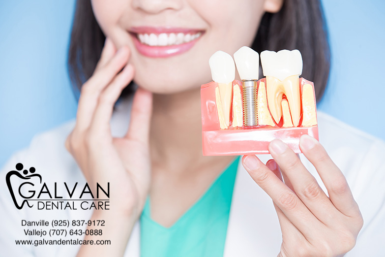 Galvan Dental Care | 480 Redwood St Suite 30, Vallejo, CA 94590 | Phone: (707) 643-0888