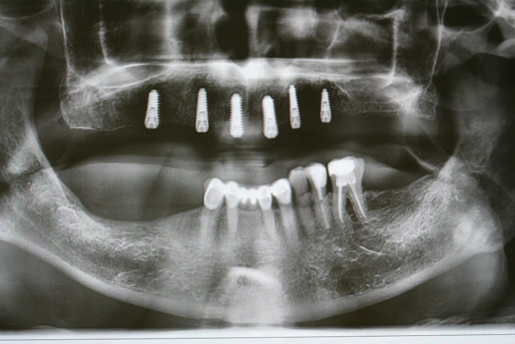 Center for Dental Implants Bill Choby DMD PC | Northgate Square, 99-1 Northgate Sq #100, Greensburg, PA 15601, USA | Phone: (724) 205-6449