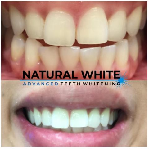 Natural White Clinical Teeth Whitening | 2993 Sandy Plains Rd Suite 125 Office 4, Marietta, GA 30066, USA | Phone: (704) 966-9090