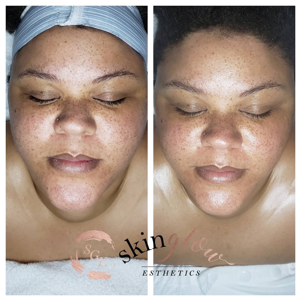 Skin Glow Esthetics | 380 Lowell St Suite 202B, Wakefield, MA 01880, USA | Phone: (978) 882-2833