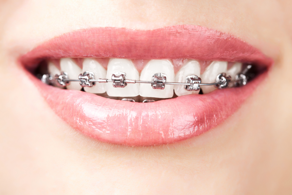 Tipton Orthodontics | 3770 Due W Rd # 100, Marietta, GA 30064, USA | Phone: (770) 428-0283