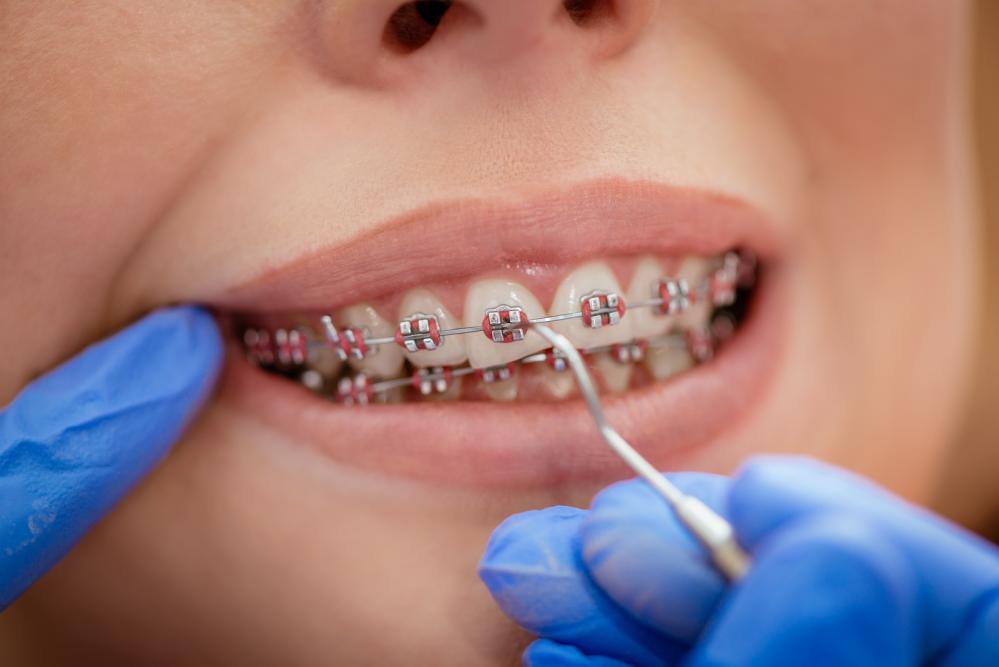 Precision Orthodontics | 13022 Pearl Rd, Strongsville, OH 44136, USA | Phone: (440) 238-0770