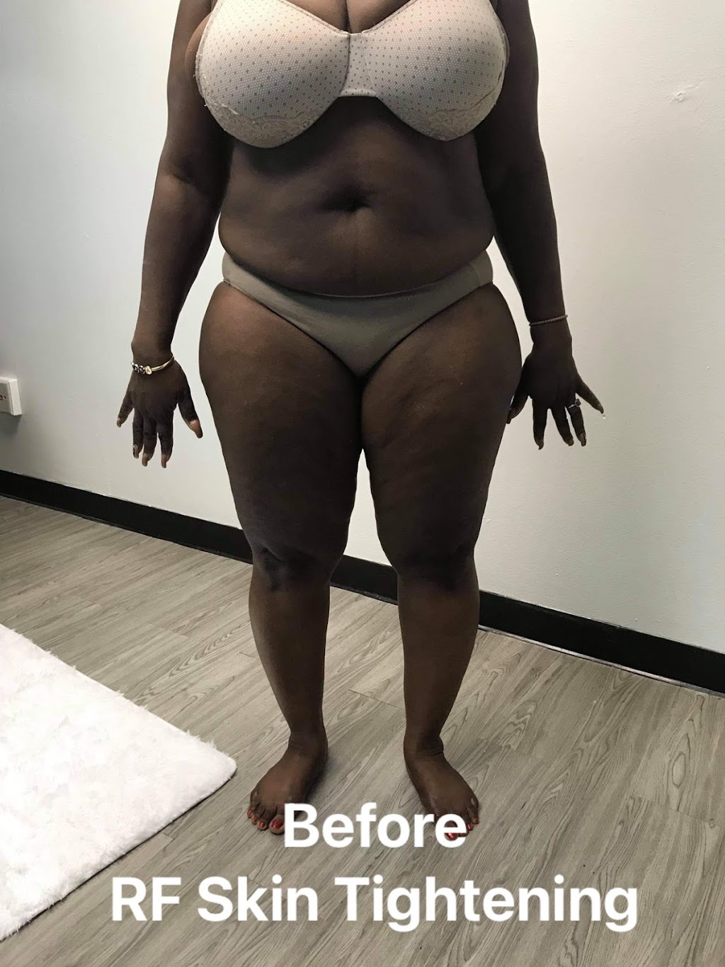 My Preferred Body Spa - Body Sculpting (In Office or Mobile) | 3535 Marvin D. Love Fwy #1, Dallas, TX 75224, USA | Phone: (469) 409-4545