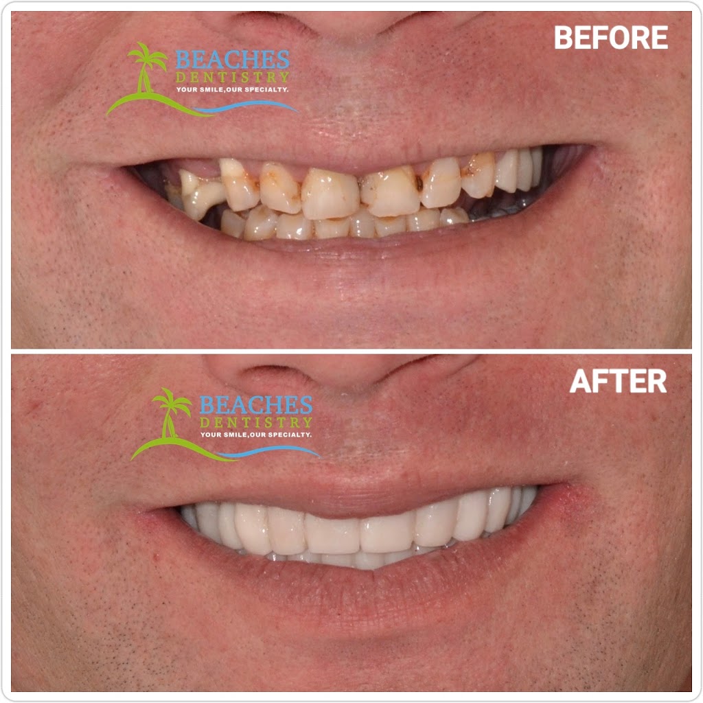 Beaches Dentistry - Implants & Prosthodontics | 324 3rd Ave N, Jacksonville Beach, FL 32250, USA | Phone: (904) 246-6714