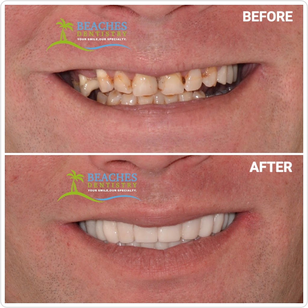 Beaches Dentistry - Implants & Prosthodontics | 324 3rd Ave N, Jacksonville Beach, FL 32250 | Phone: (904) 246-6714