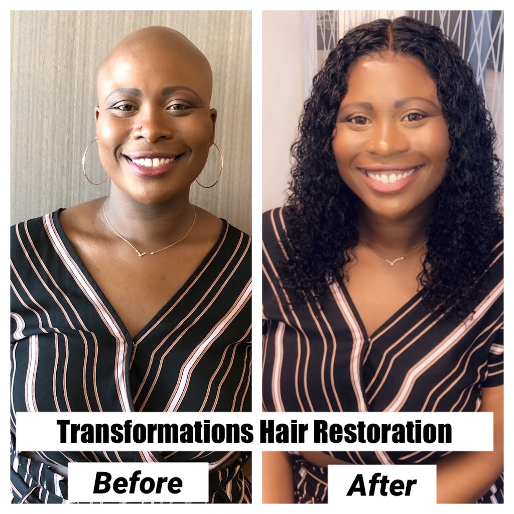 Transformations Hair Restoration Inc. | 32 Triangle Park Dr, Cincinnati, OH 45246, USA | Phone: (513) 824-8648