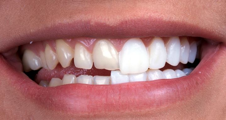 Porcelain Veneers Dental Center Brooklyn | Eco Dental NY | 2384 Ocean Ave FL 1, Brooklyn, NY 11229, USA | Phone: (718) 483-9233