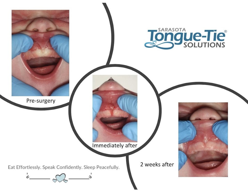 Sarasota Tongue-Tie Solutions | 7307 Merchant Ct, Lakewood Ranch, FL 34240, USA | Phone: (941) 907-7762