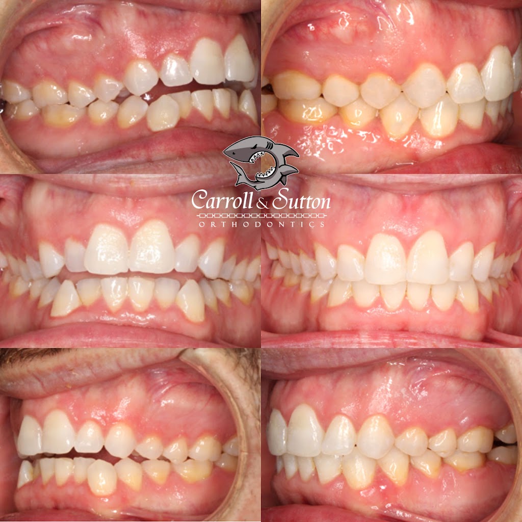 Carroll & Sutton Orthodontics | 8208 Tourist Center Dr, Bradenton, FL 34201, USA | Phone: (941) 366-1612