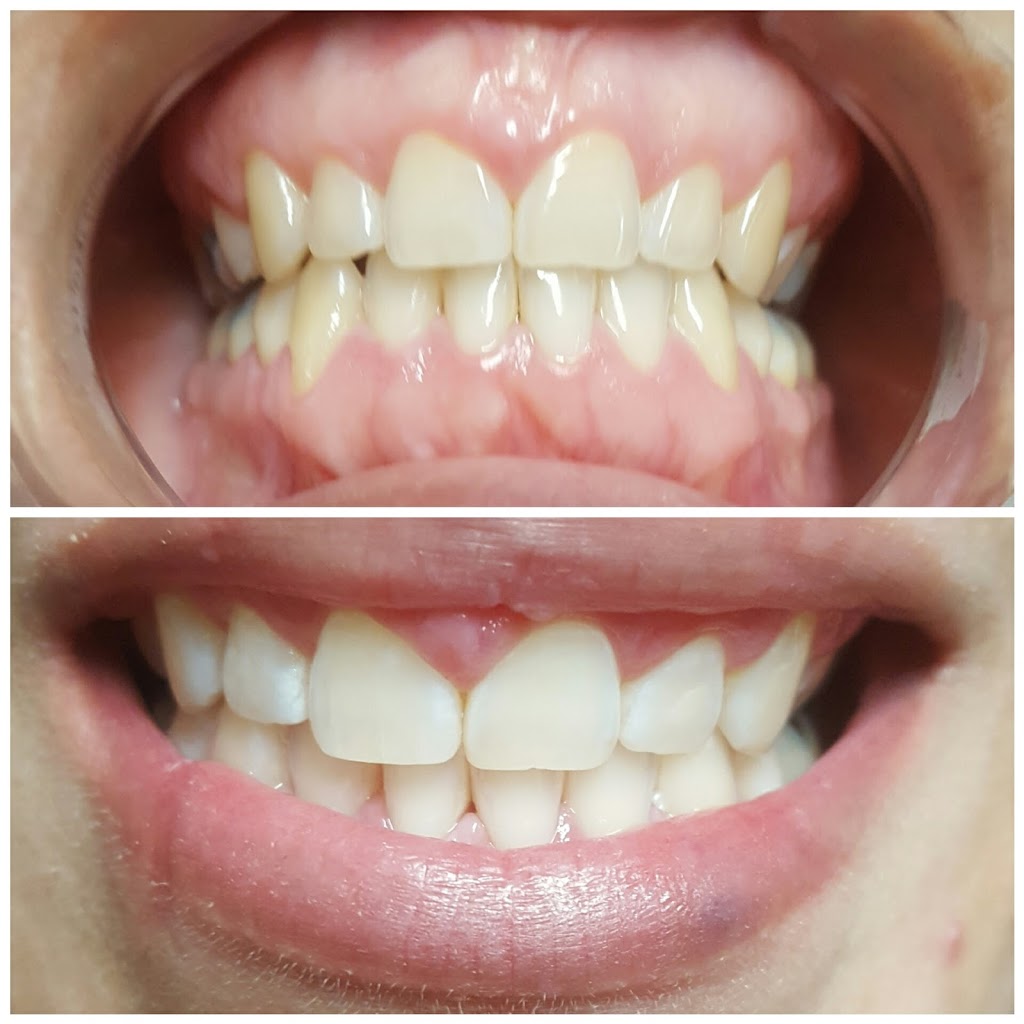 New Smiles Teeth Whitening | 222 Grifford Dr, Kissimmee, FL 34758, USA | Phone: (407) 279-0490