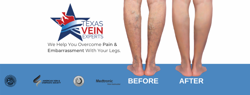 Texas Vein Experts - Waxahachie | 1626 W Main St #107, Waxahachie, TX 75165, USA | Phone: (817) 668-1360