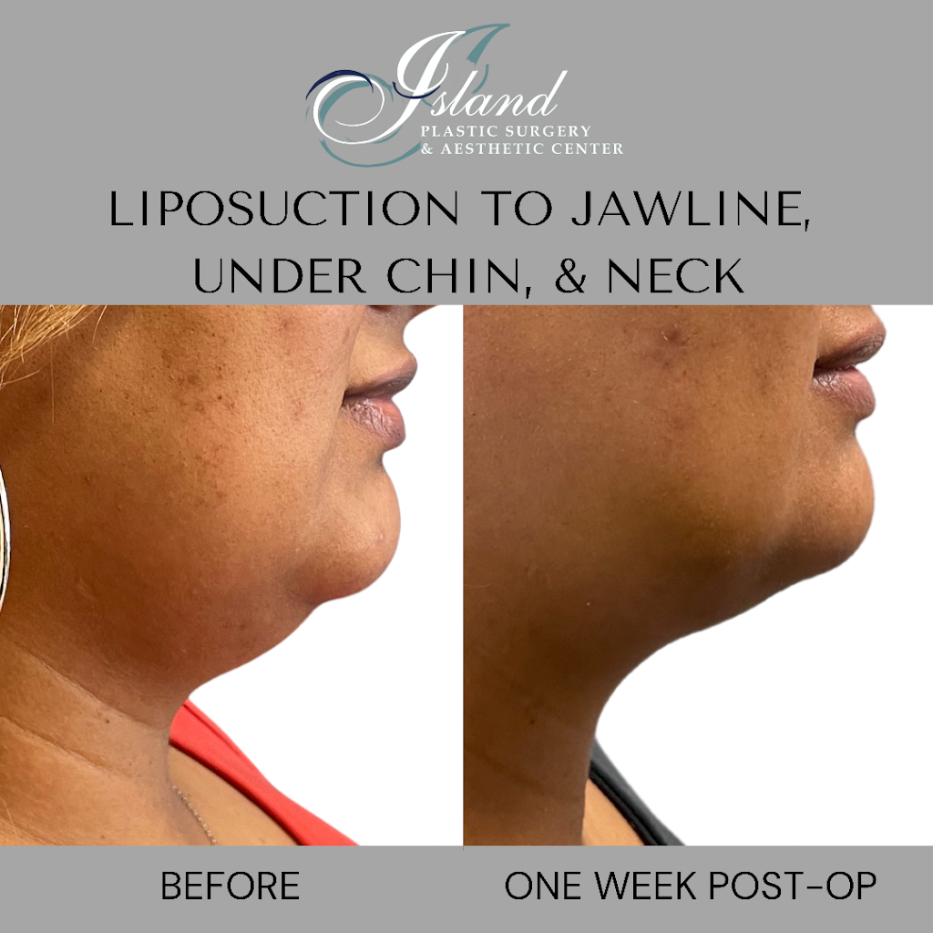 Island Plastic Surgery | 190 E Jericho Turnpike Suite 202, Mineola, NY 11501, USA | Phone: (516) 977-9922