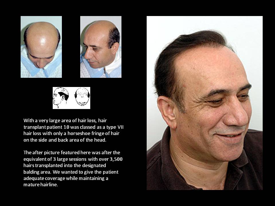 International Hair Surgical Group (IHSG) | 1150 Amboy Ave, Edison, NJ 08837 | Phone: (908) 222-0700