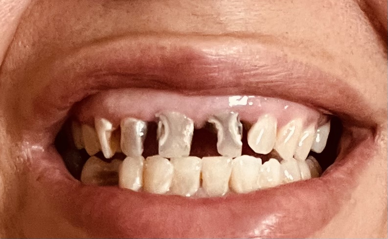 Stone Arch Dental | 8097 Hwy 65 NE #104, Spring Lake Park, MN 55432, USA | Phone: (763) 307-8689