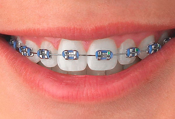 Schulten Orthodontics | 5207 Commerce Crossings Dr, Louisville, KY 40229, USA | Phone: (502) 968-7878