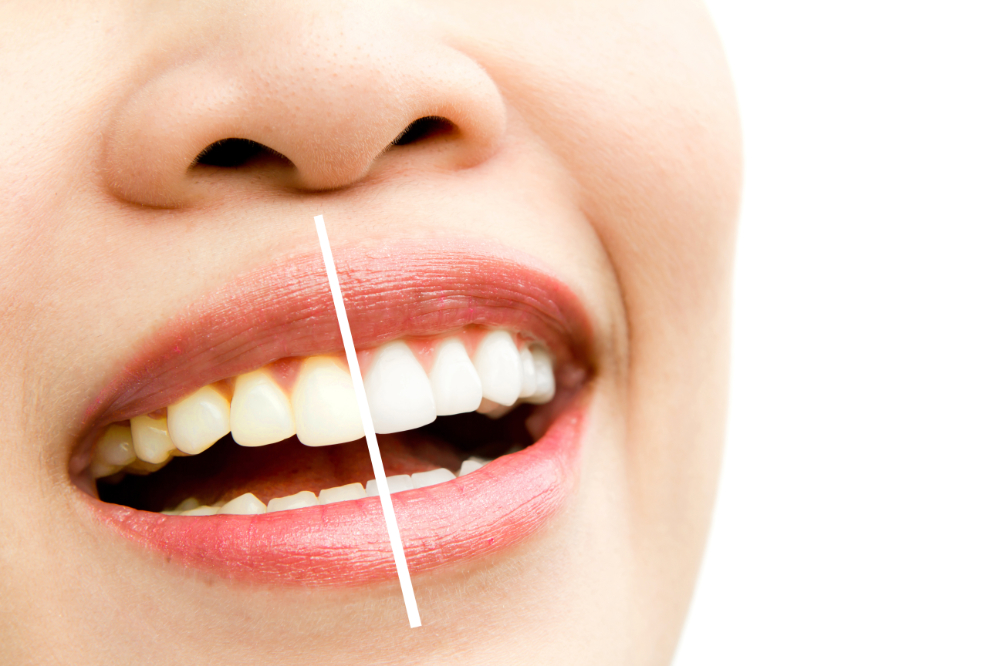 First Impressions Family Dental Care | 522 IN-32, Westfield, IN 46074, USA | Phone: (317) 867-5511