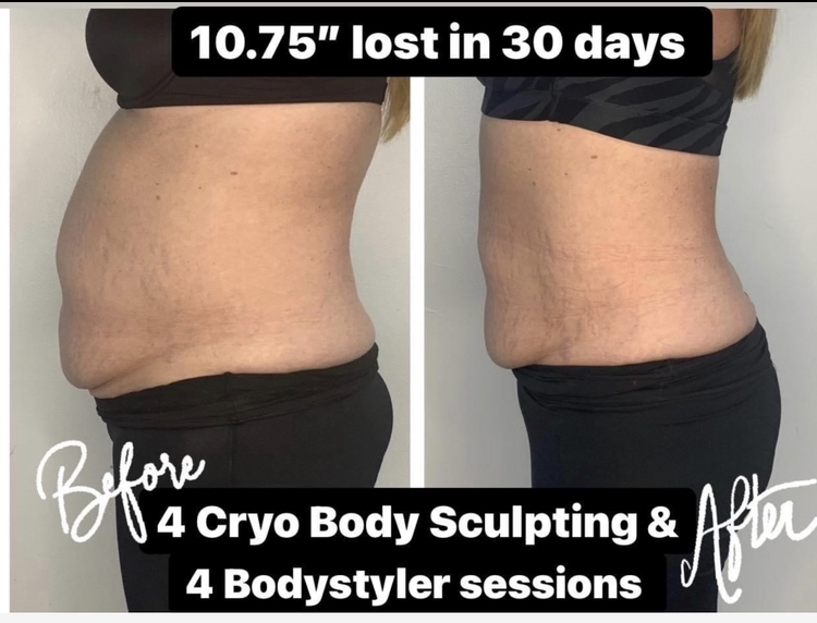 Cryo Rejuvenation | 1741 Bertino Way, Rockwall, TX 75032, USA | Phone: (469) 745-5535