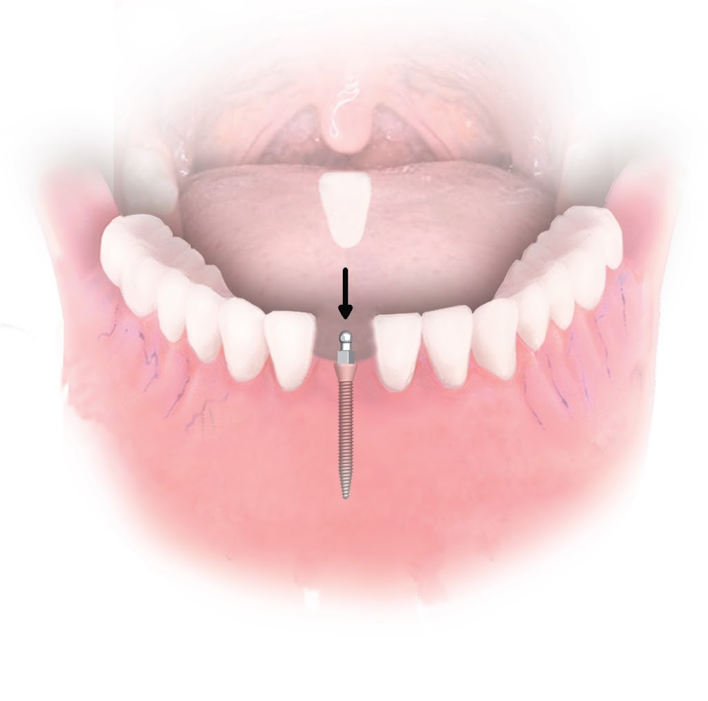 Dental Implant Solutions Rockwall, TX | 1350 Summer Lee Dr, Rockwall, TX 75032, USA | Phone: (469) 264-5155
