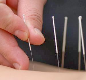 Dr. Joo Acupuncture. Inc (JW Health Care) | 8847 Imperial Hwy. Suite D, Downey, CA 90242, USA | Phone: (562) 861-1177