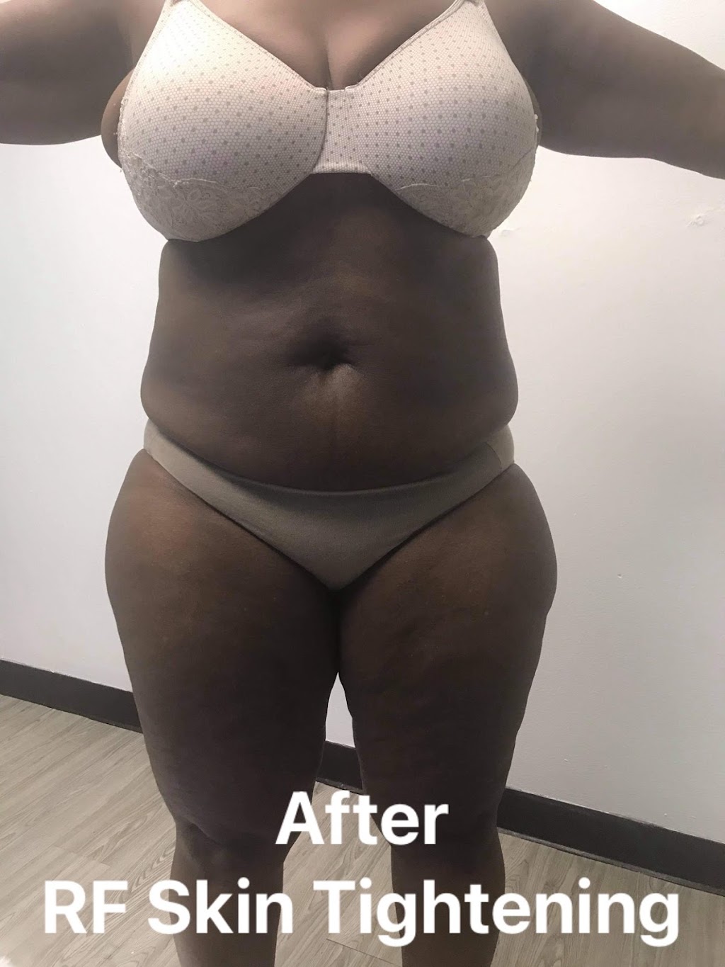 My Preferred Body Spa - Body Sculpting (In Office or Mobile) | 3535 Marvin D. Love Fwy #1, Dallas, TX 75224, USA | Phone: (469) 409-4545