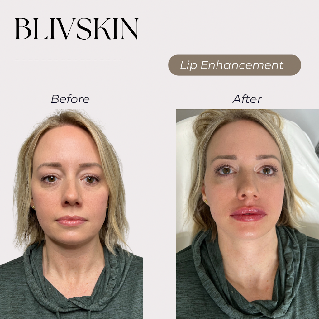 BLIV SKIN Medical Spa | 160 NW Gilman Blvd Suite 311, Issaquah, WA 98027, USA | Phone: (206) 833-0079