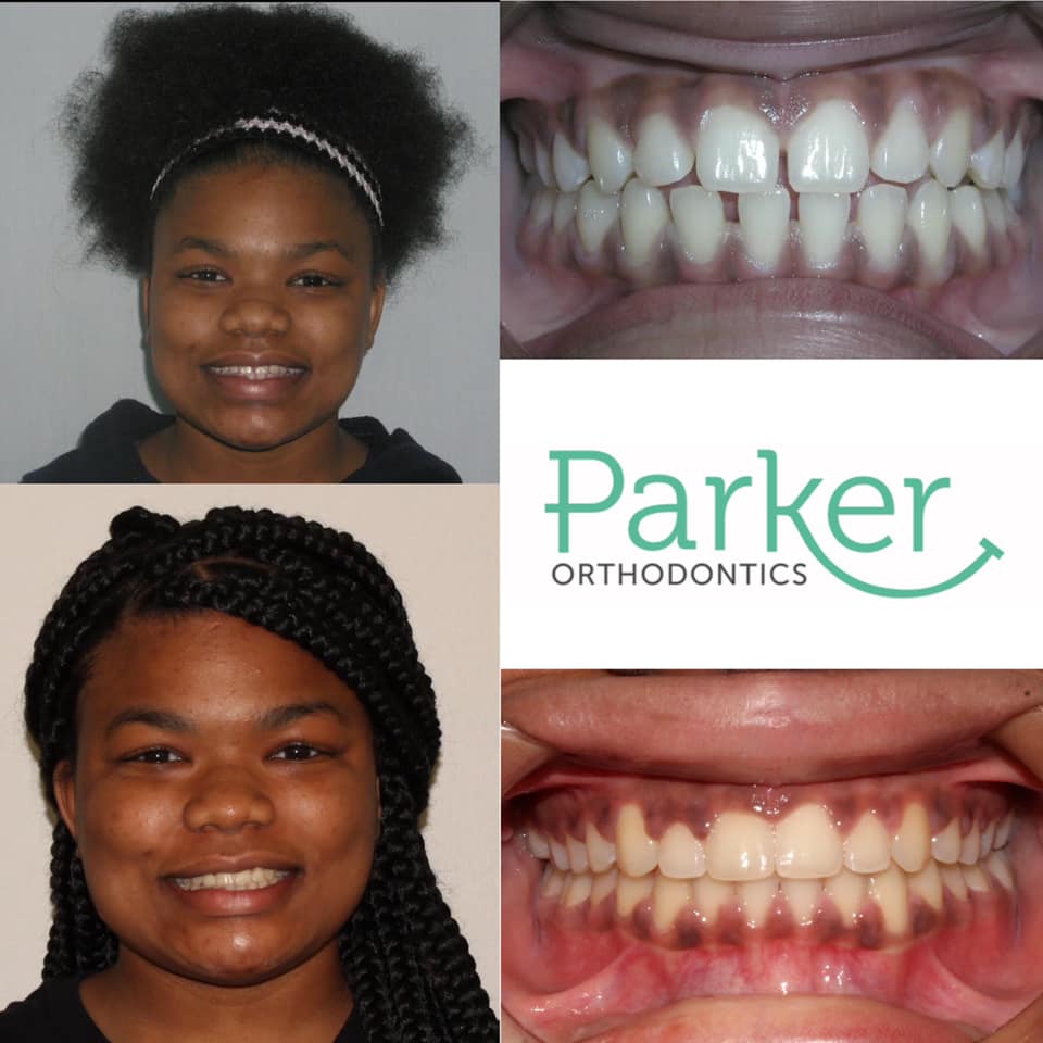 Parker Orthodontics | 200 Railroad Ave, Donaldsonville, LA 70346, USA | Phone: (225) 473-6434