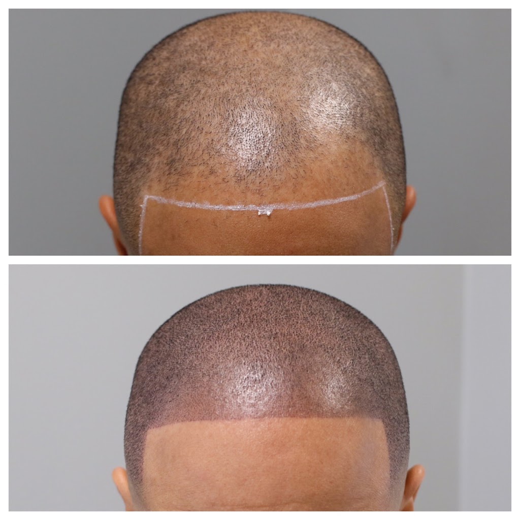 Hairline Plus | 1050 Stuyvesant Ave, Union, NJ 07083, USA | Phone: (908) 318-4018