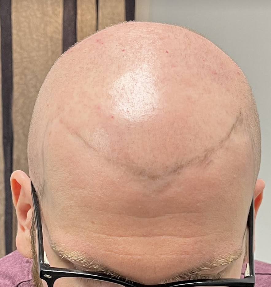 New You Ink Scalp Micropigmentation and Aesthetics | 1348 Sharon Copley Rd, Wadsworth, OH 44281, USA | Phone: (216) 626-5311