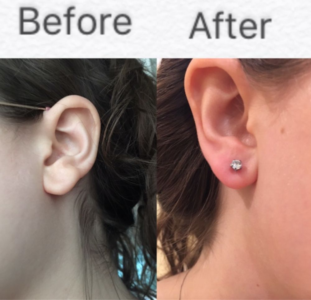 Dr. Sharon Wollaston Medical Ear Piercing | 11549 Chiquita St, Studio City, CA 91604 | Phone: (818) 522-7763