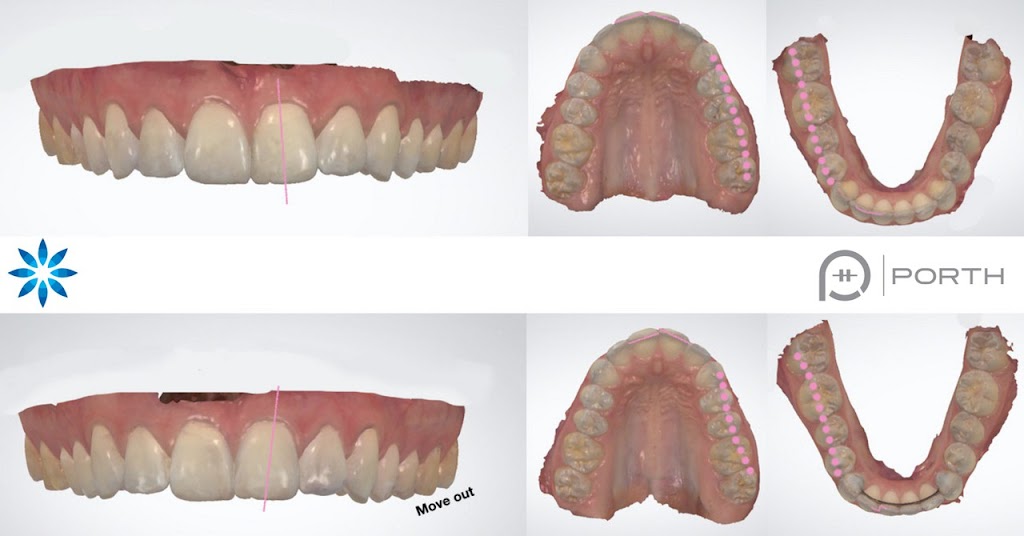 Porth Personalized Orthodontics Sammamish | 22620 SE 4th St Ste 210, Sammamish, WA 98074, USA | Phone: (425) 526-2060