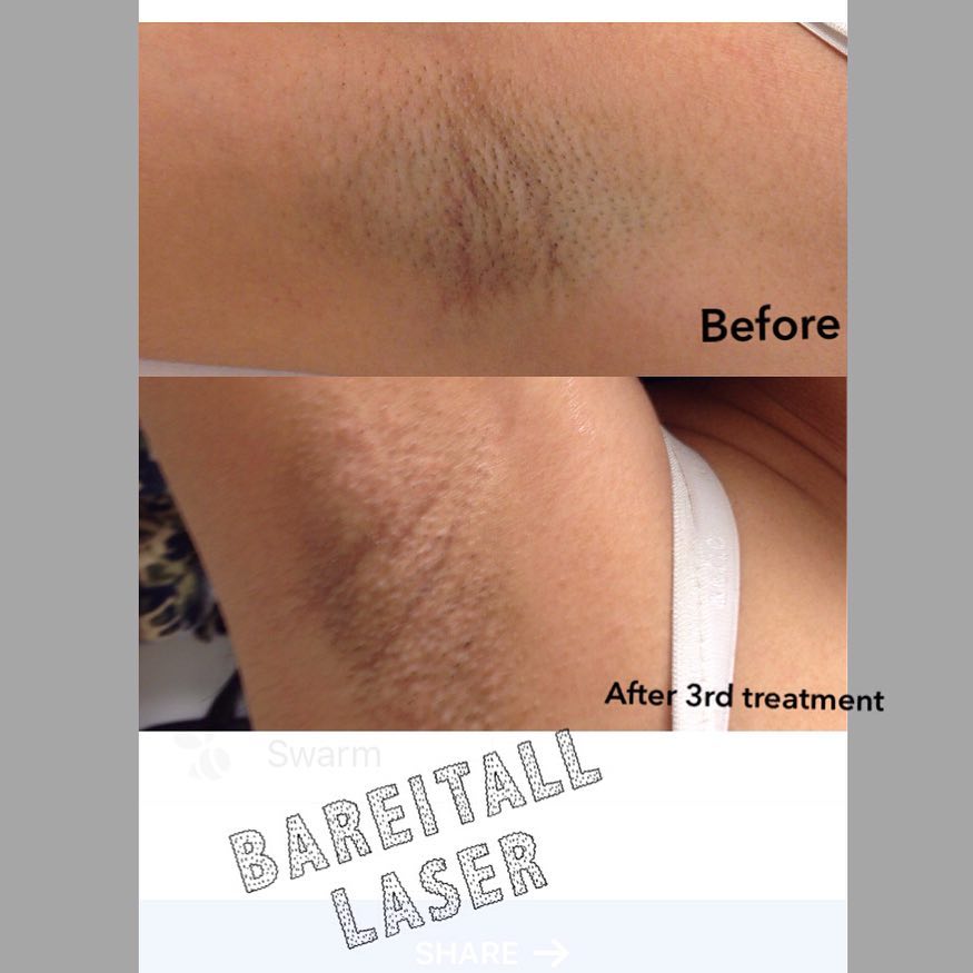 Bare It All Laser | 2472 Sycamore Ave, Wantagh, NY 11793, USA | Phone: (929) 251-2789