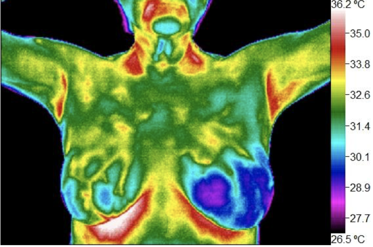 InfraRead: Thermography for Wellness | 8700 Auburn Folsom Rd suite 300, Granite Bay, CA 95746 | Phone: (916) 741-2522