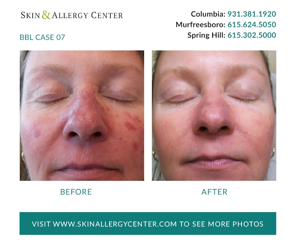 Skin & Allergy Center | 1229 Reserve Blvd Suite 200, Spring Hill, TN 37174, USA | Phone: (615) 302-5000