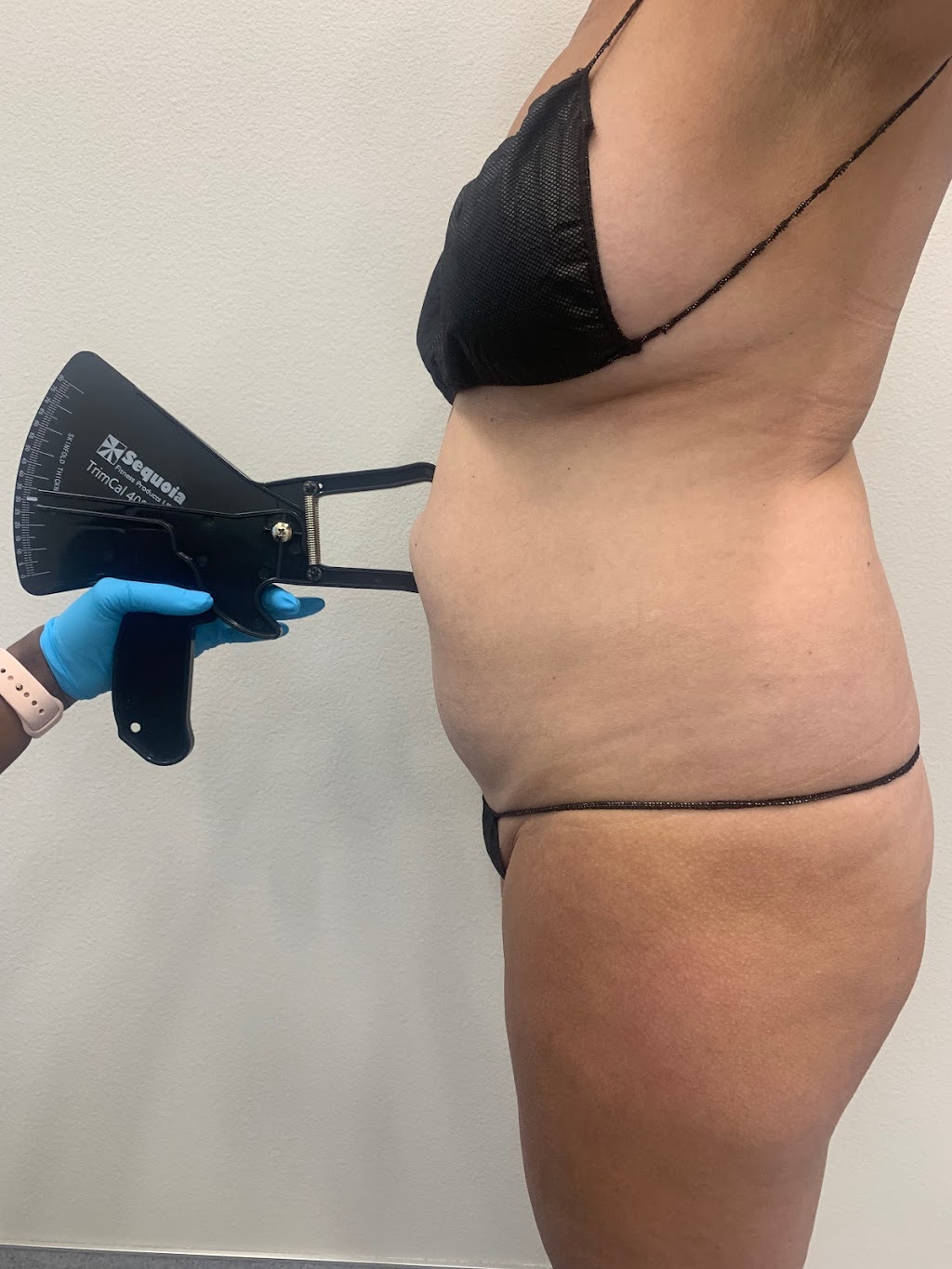 Premier Liposuction | 2860 S Jones Blvd Suite 100, Las Vegas, NV 89146, USA | Phone: (702) 553-3549