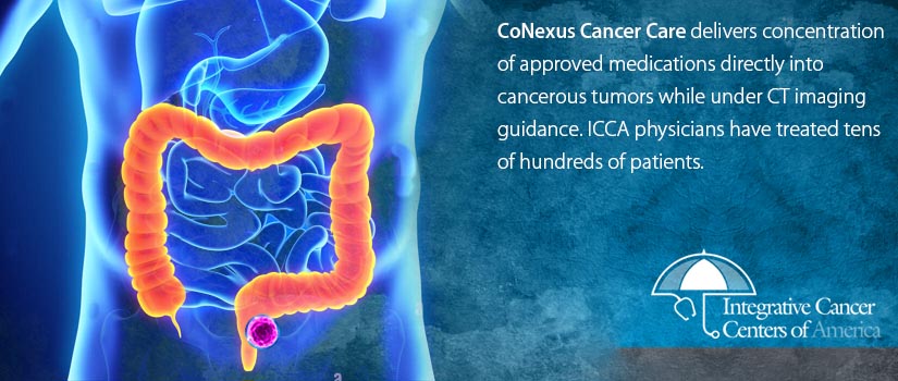 Integrative Cancer Centers of America | 4370 La Jolla Village Dr, San Diego, CA 92122, United States | Phone: (888) 526-6398