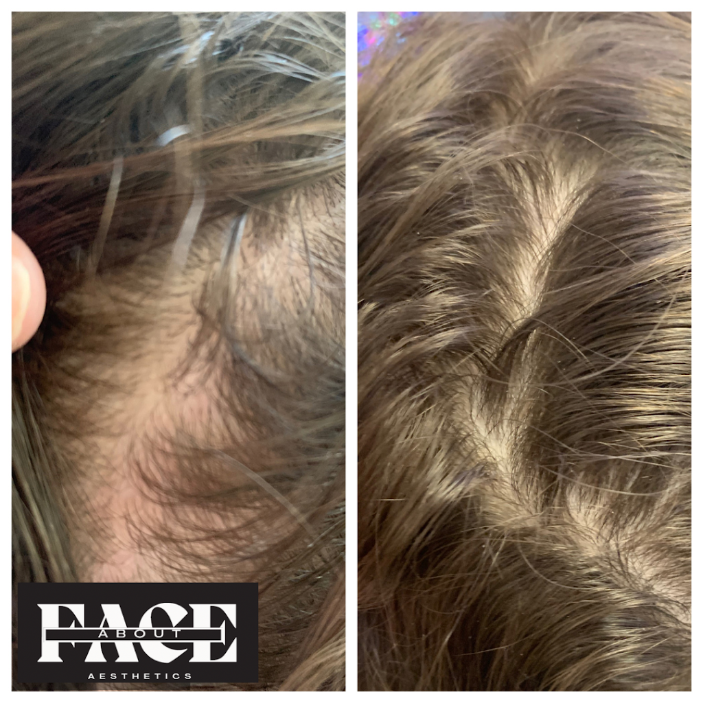 About Face Aesthetics | Studio 12, 588 N Lincoln Ave, Loveland, CO 80537, USA | Phone: (970) 744-3064 About Face Aesthetics | Studio 12, 588 N Lincoln Ave, Loveland, CO 80537, USA | Phone: (970) 744-3064