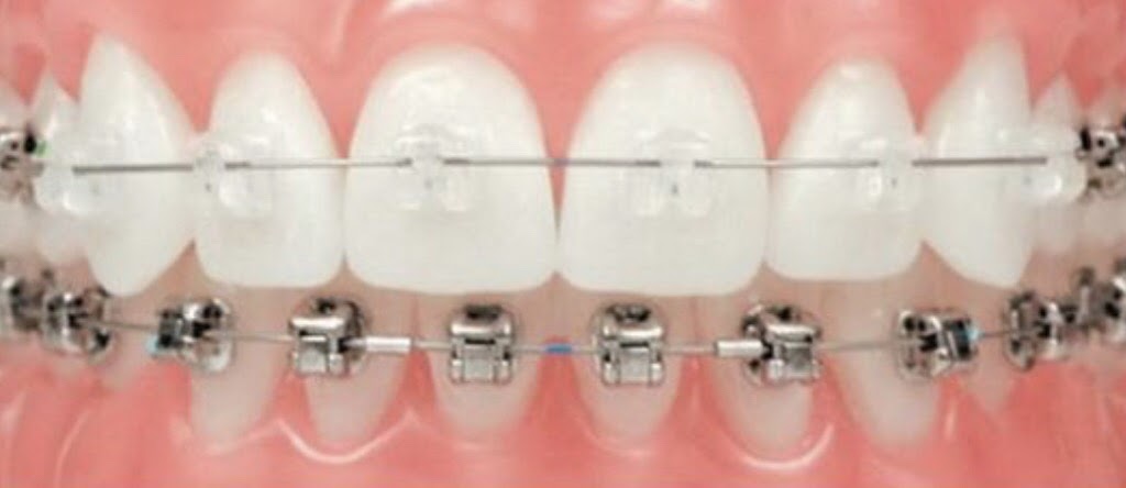 Henn Orthodontics | 4816 Greenwood Rd, Louisville, KY 40258, USA | Phone: (502) 935-7212
