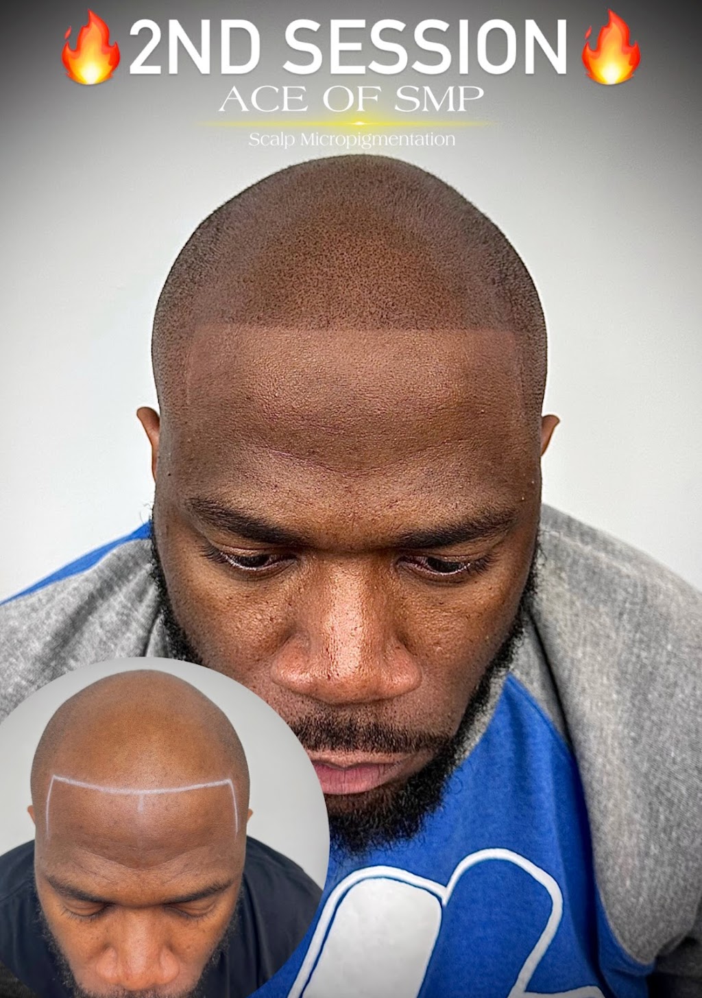 SCALP MICROPIGMENTATION | 2111 W Lincoln Hwy, Merrillville, IN 46410, USA | Phone: (630) 486-4502