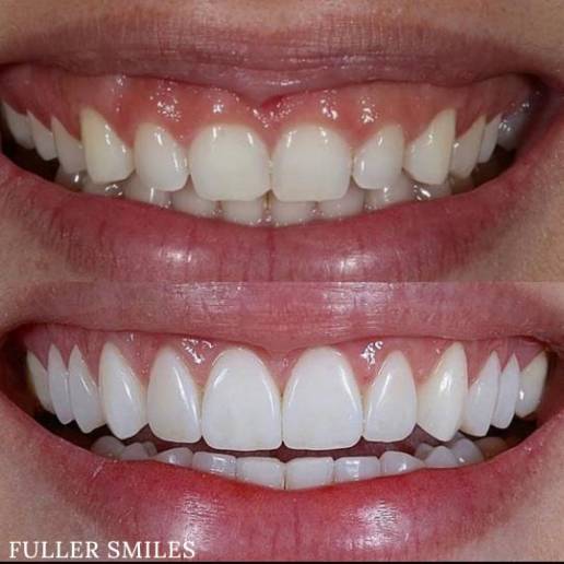 Fuller Smiles - Dentist - Northridge | 18915 Nordhoff St #1, Northridge, CA 91324 | Phone: (818) 772-7096