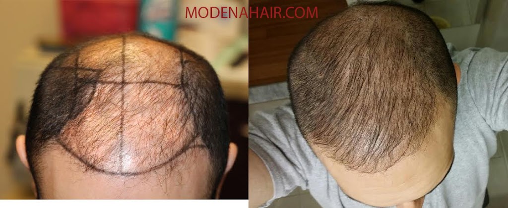 Modena Hair Transplant Institute | 2629 W Horizon Ridge Pkwy Suite #110, Henderson, NV 89052, USA | Phone: (702) 966-5134 Modena Hair Transplant Institute | 2629 W Horizon Ridge Pkwy Suite #110, Henderson, NV 89052, USA | Phone: (702) 966-5134