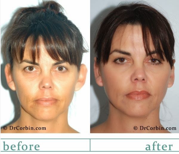 Dr. Corbin Plastic Surgery | 380 W Central Ave Suite 310, Brea, CA 92821, USA | Phone: (714) 671-3033