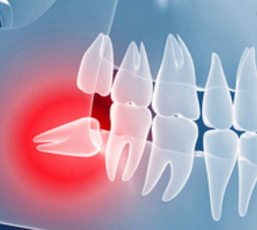 Silicon Valley Wisdom Teeth | 5710 Cahalan Ave Building 8K, San Jose, CA 95123, USA | Phone: (408) 578-5911