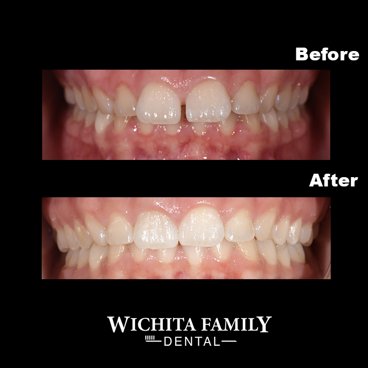 Wichita Family Dental West | 1445 N Ridge Rd, Wichita, KS 67212, USA | Phone: (316) 333-5697