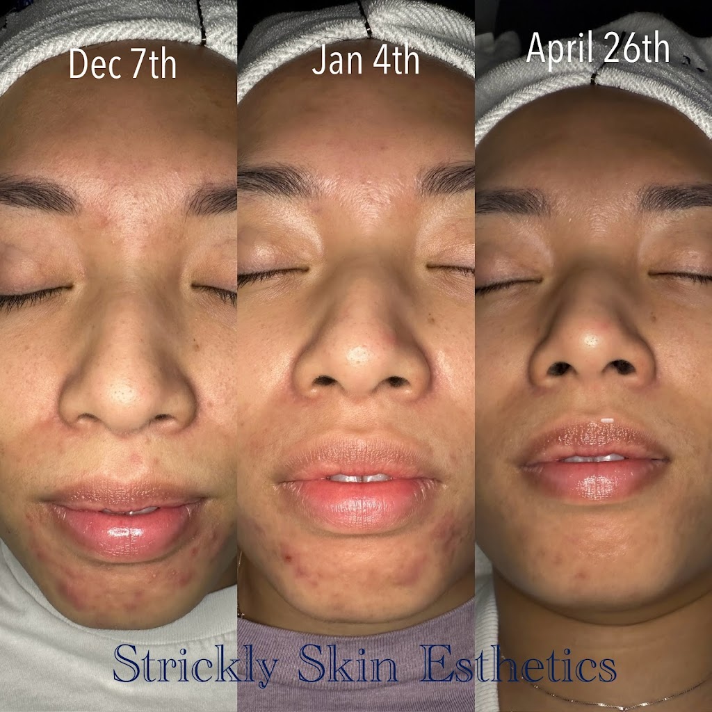 Strickly Skin Esthetics | 105 E Oak St Ste. 101, Mansfield, TX 76063, USA | Phone: (817) 320-8485
